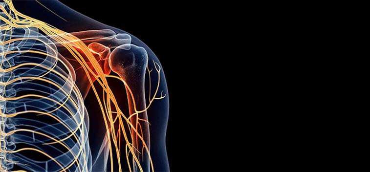 Patient experiencing Brachial Plexus Neuropathy and in need of the neuropathy treatment protocol at South Bay Wellness Center in San Jose