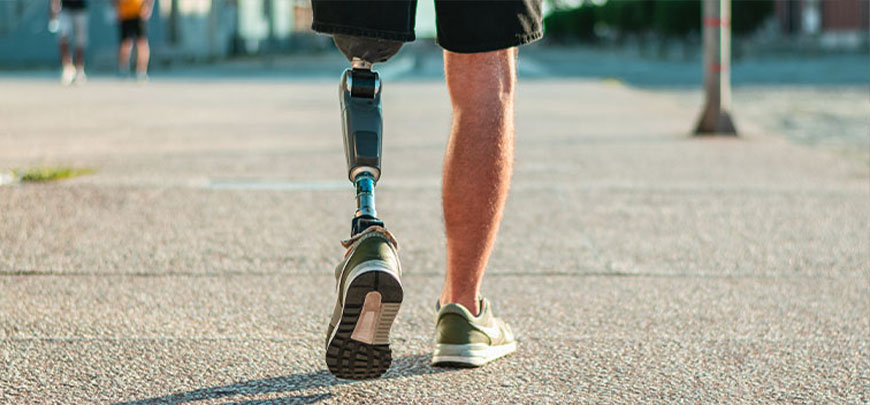 Patient experiencing Phantom Limb Syndrome and in need of the neuropathy treatment protocol at South Bay Wellness Center in San Jose